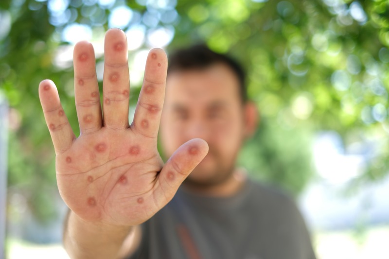 A person holds up a hand with multiple red, circular sores or lesions on the palm and fingers, outdoors with greenery in the background.